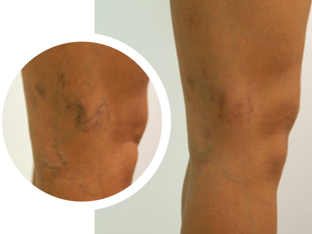 vidabella procedimientos menores micro varices